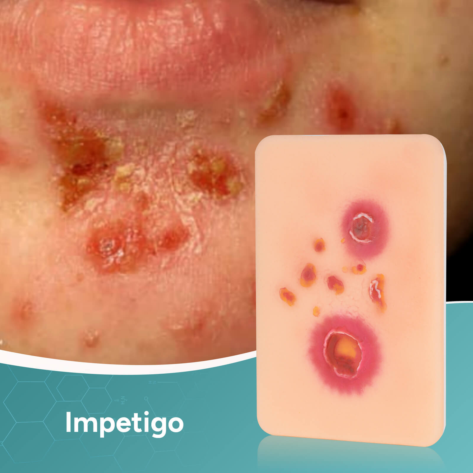 Palm-Sized Bacterial Skin Infection Wound Models