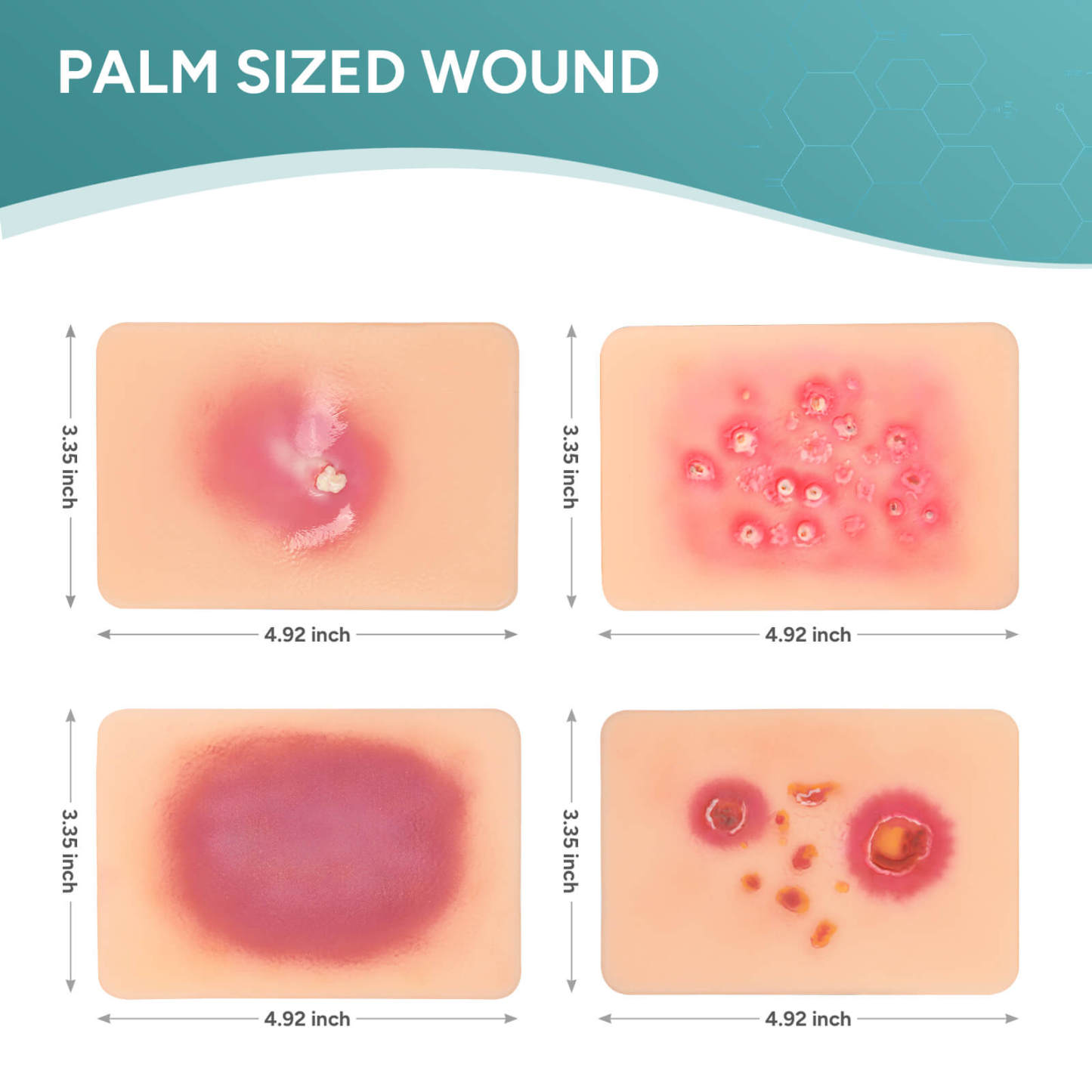 Palm-Sized Bacterial Skin Infection Wound Models