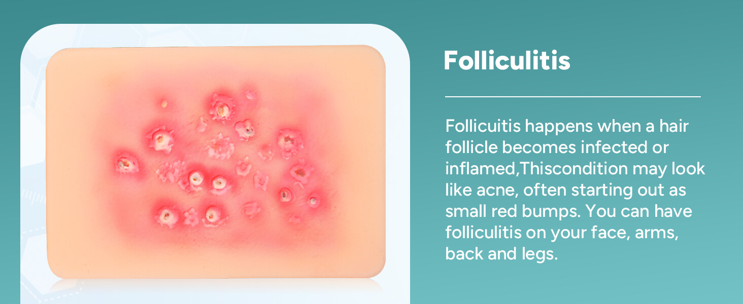 Bacterial Infected Wound Model - Folliculitis