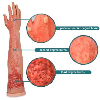 Adult Wound Arm with Second and Third Degree Burns
