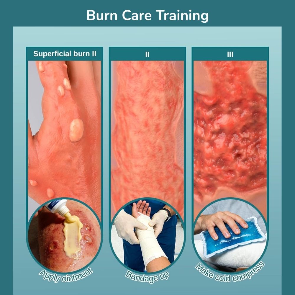 Arm with Multi-degree Burns for Burn Wound Care Training