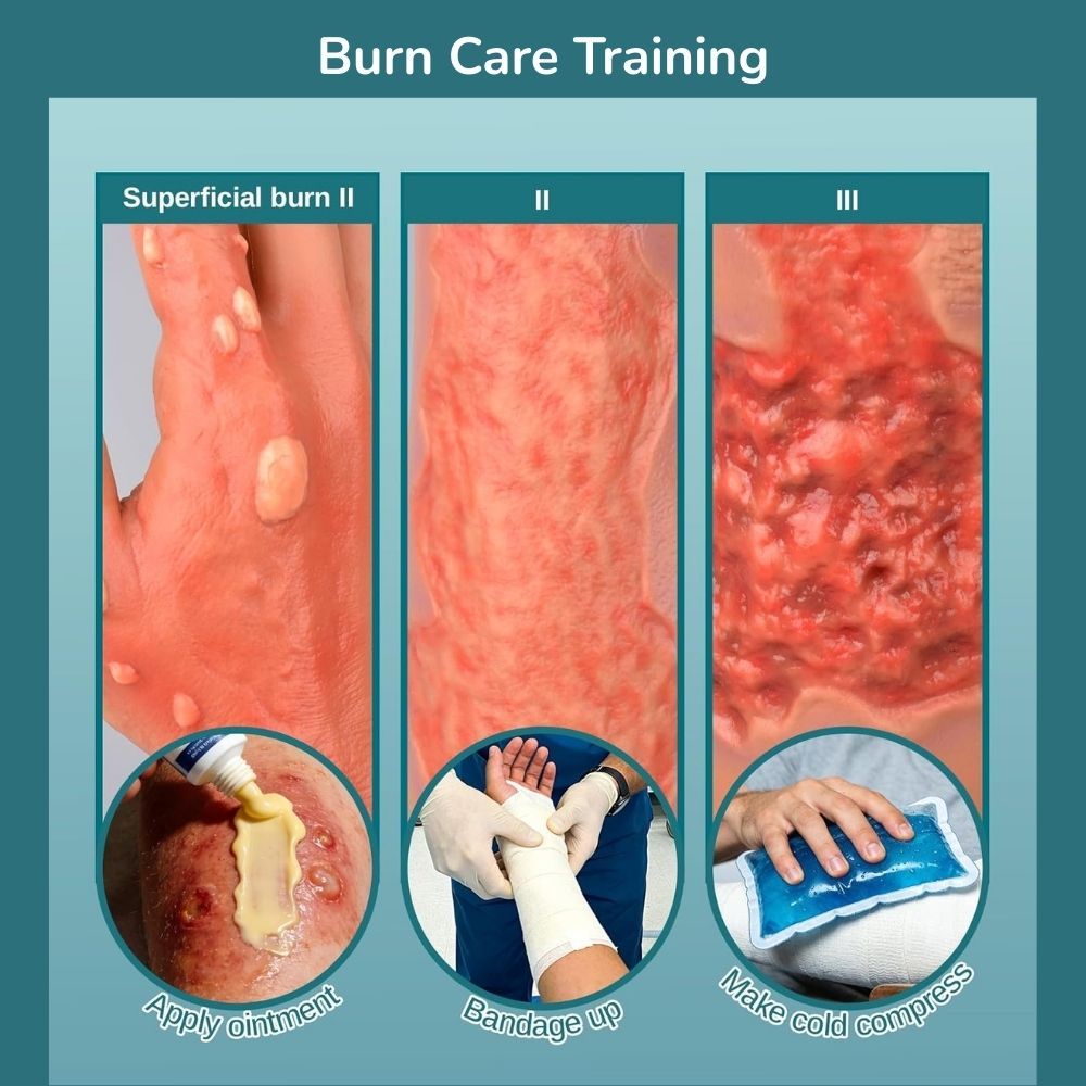 Arm with Multi-degree Burns for Burn Wound Care Training