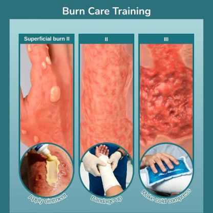 Arm with Multi-degree Burns for Burn Wound Care Training