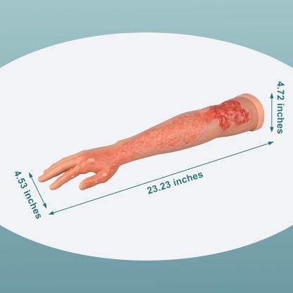 Burn Wound Arm Size