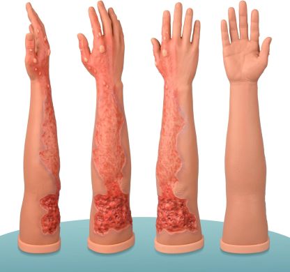 Full Arm with Realistic Multi-degree Burns