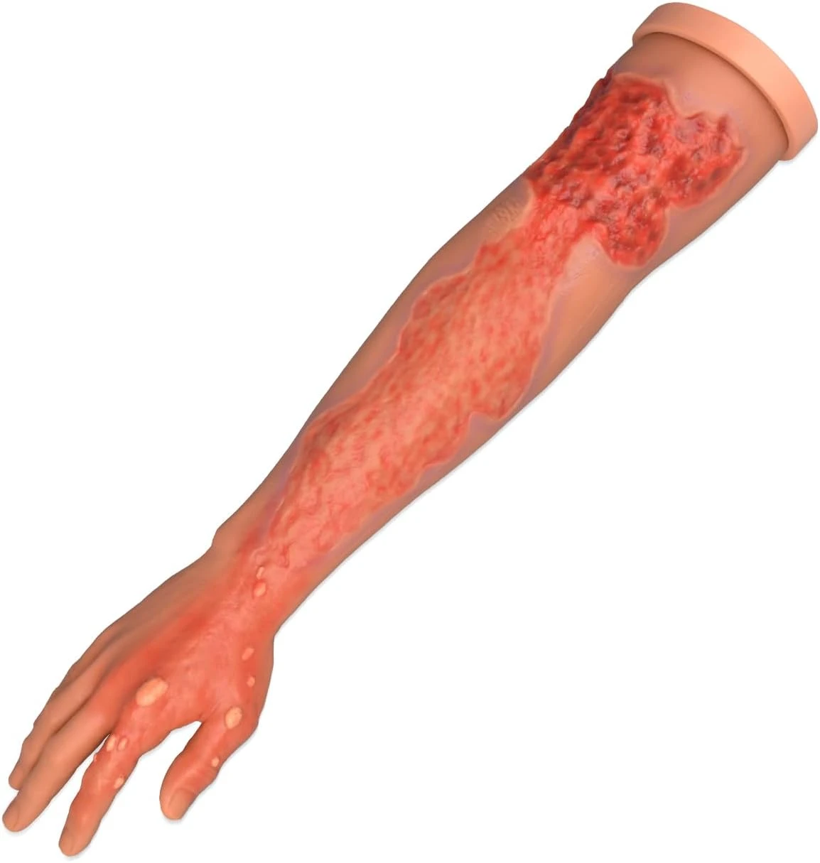 Burn Wound Model