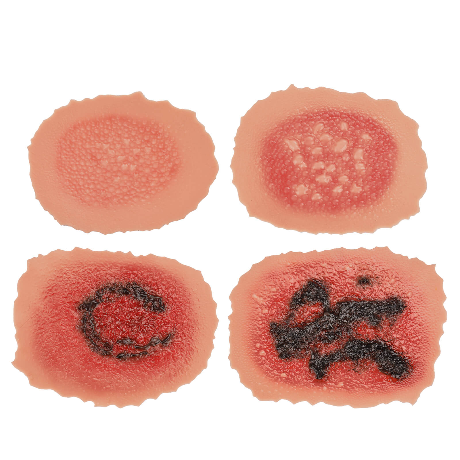 Burn Wound Moulages, 1st-4th Degree