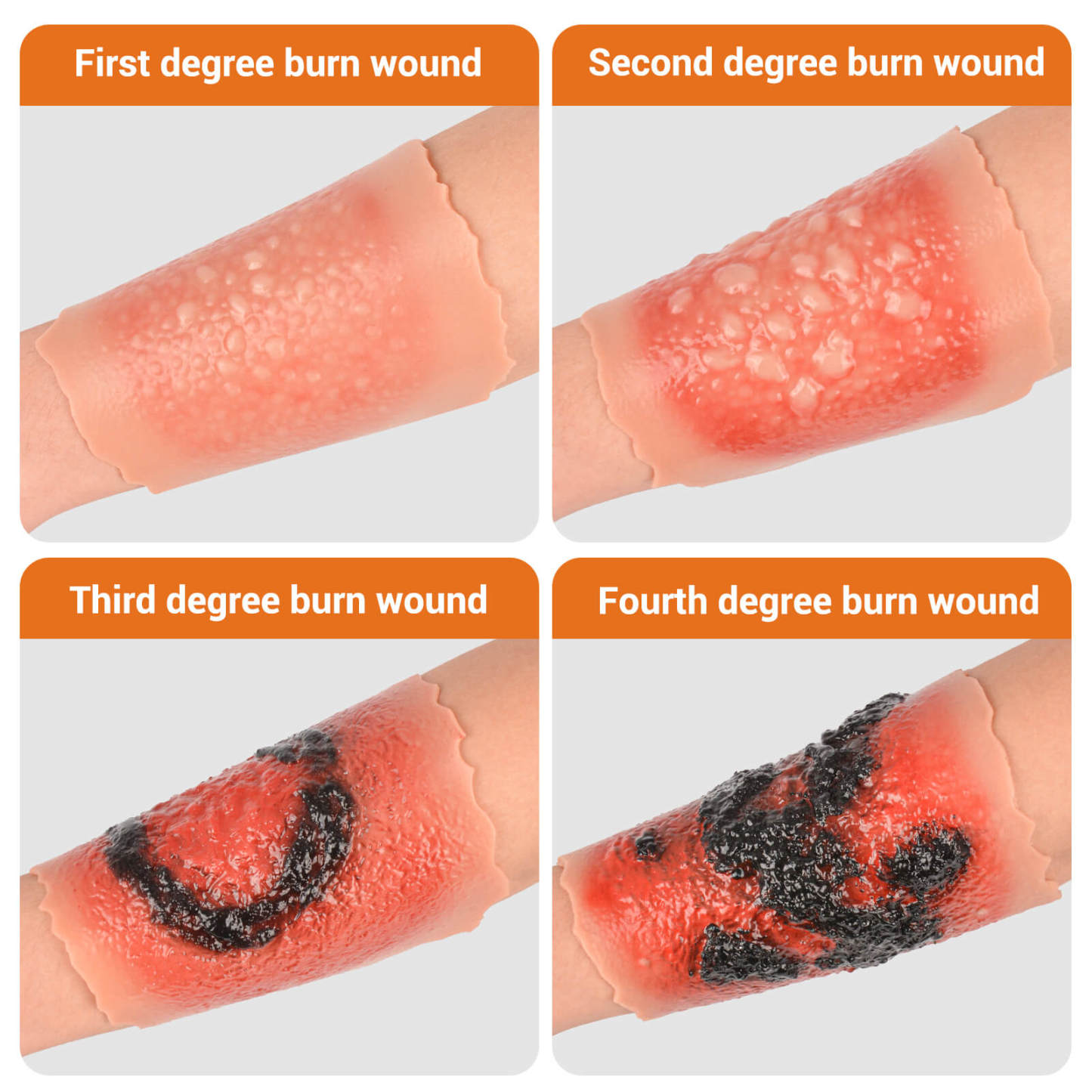Burn Wound Models, 1st-4th Degree