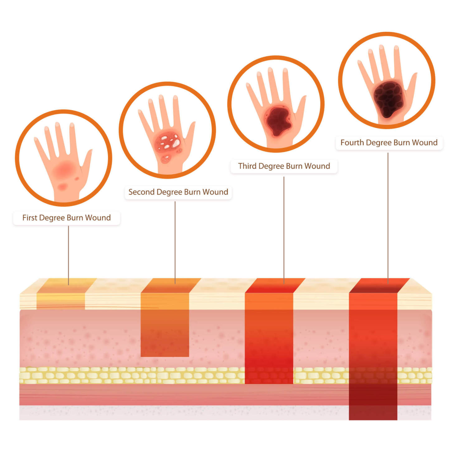 Four Degree Burn Wound Moulages