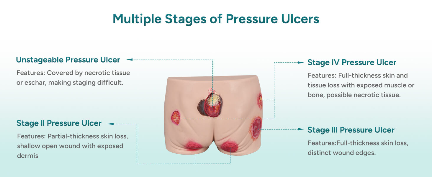 Buttock Pressure Ulcer Model with Multi-Stage Ulcer Simulation