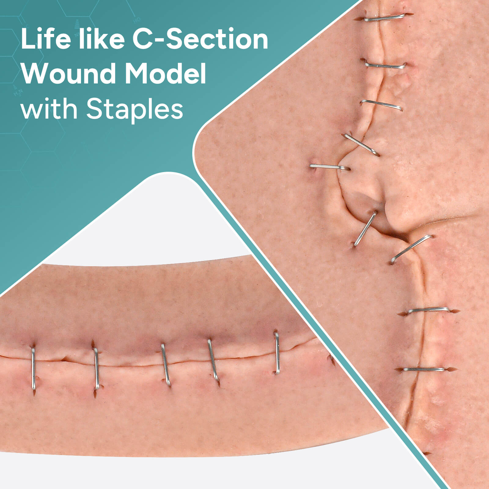 C-Section Wound Model Set with Staples