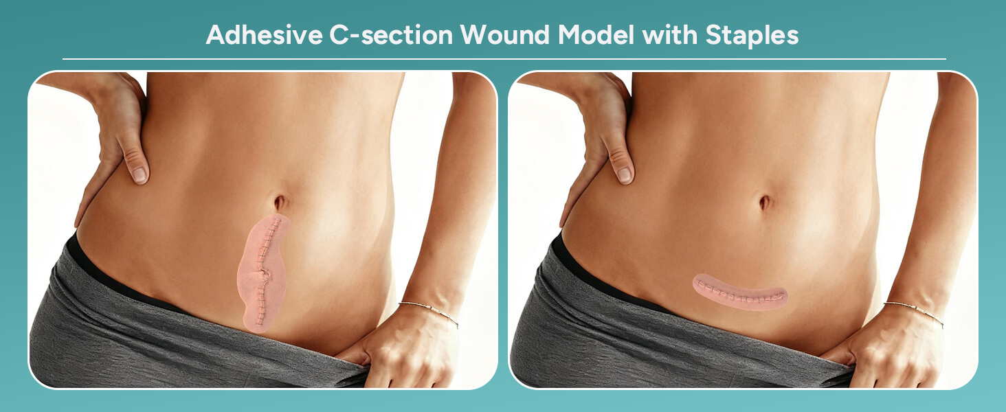 transverse and vertical C-Section Wound Model Set with Staples