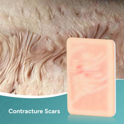 Card-sized Atrophic Scar Wound Simulation Models (Set of 3)