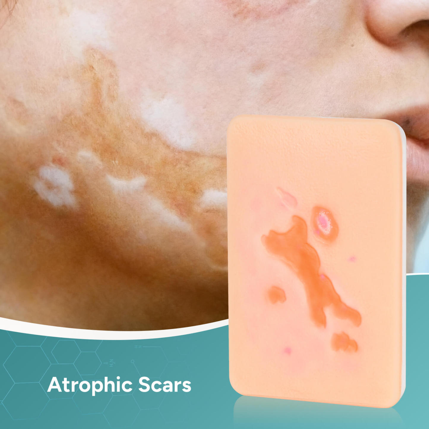 Card-sized Atrophic Scar Wound Simulation Models (Set of 3)