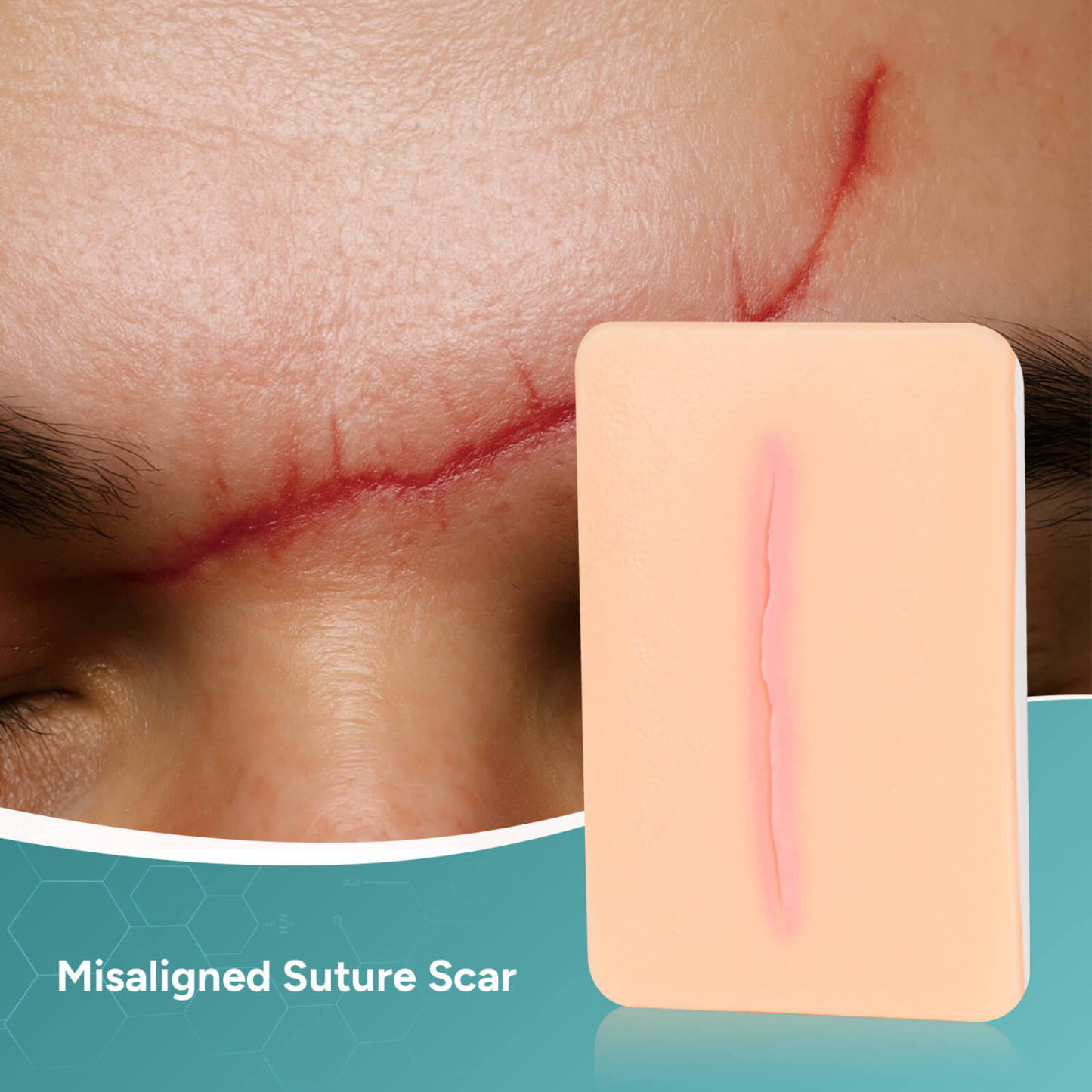 Card-sized Atrophic Scar Wound Simulation Models (Set of 3)