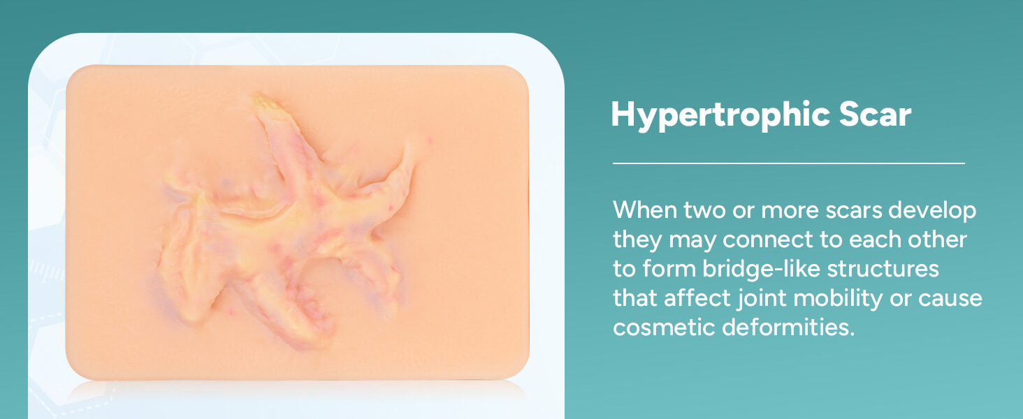 Palm-sized Hypertrophic Scar Wound Simulation Models (Set of 3)