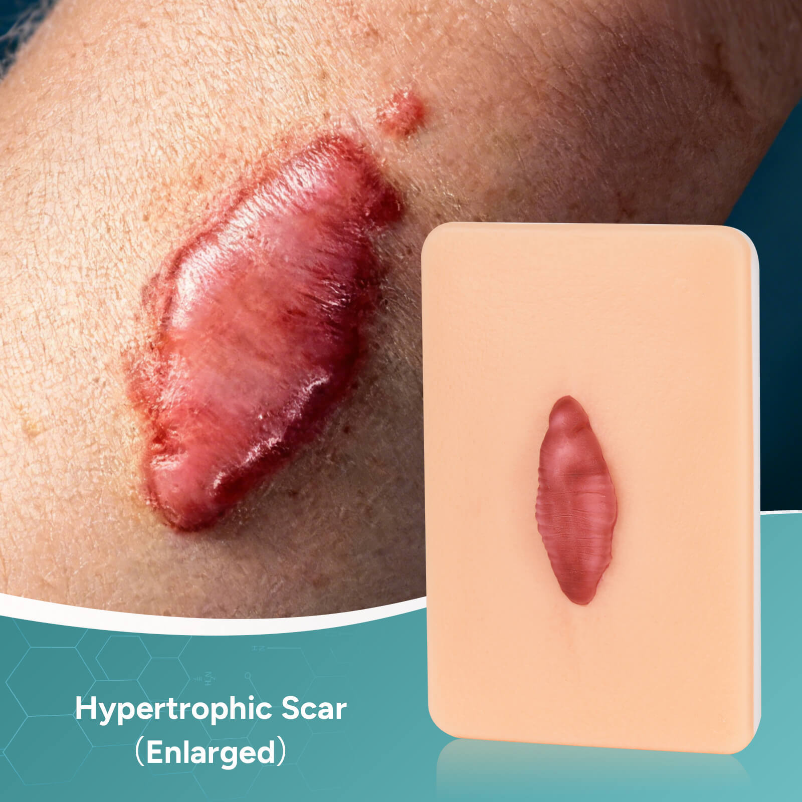 Card-sized Hypertrophic Scar Wound Simulation Models (Set of 3)