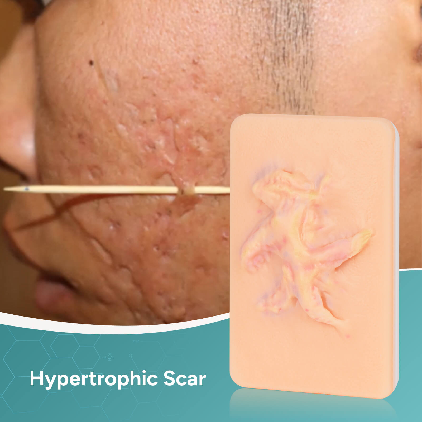 Card-sized Hypertrophic Scar Wound Simulation Models (Set of 3)