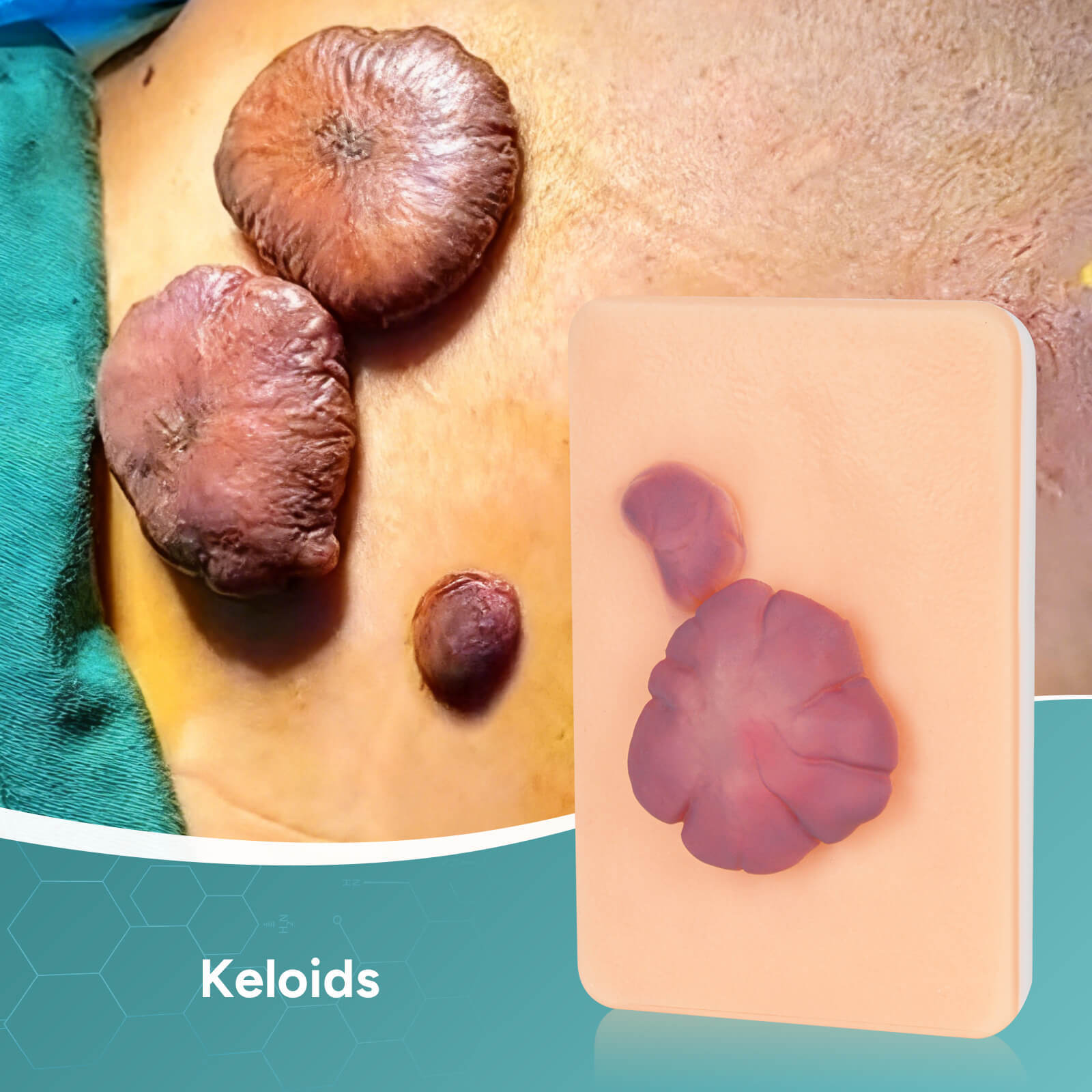 Card-sized Hypertrophic Scar Wound Simulation Models (Set of 3)