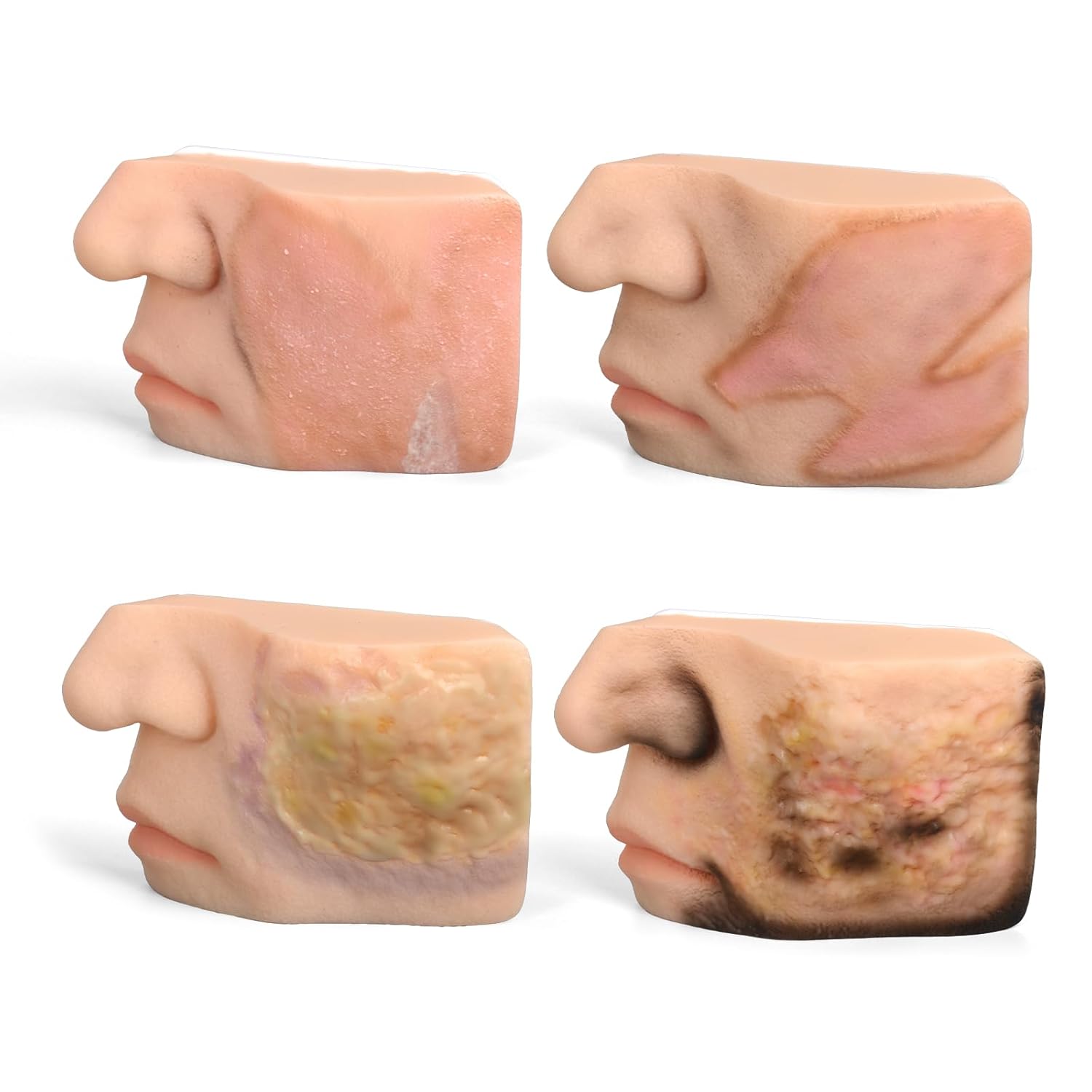 Chemical Facial Burn Wound Model – 4-Piece Set