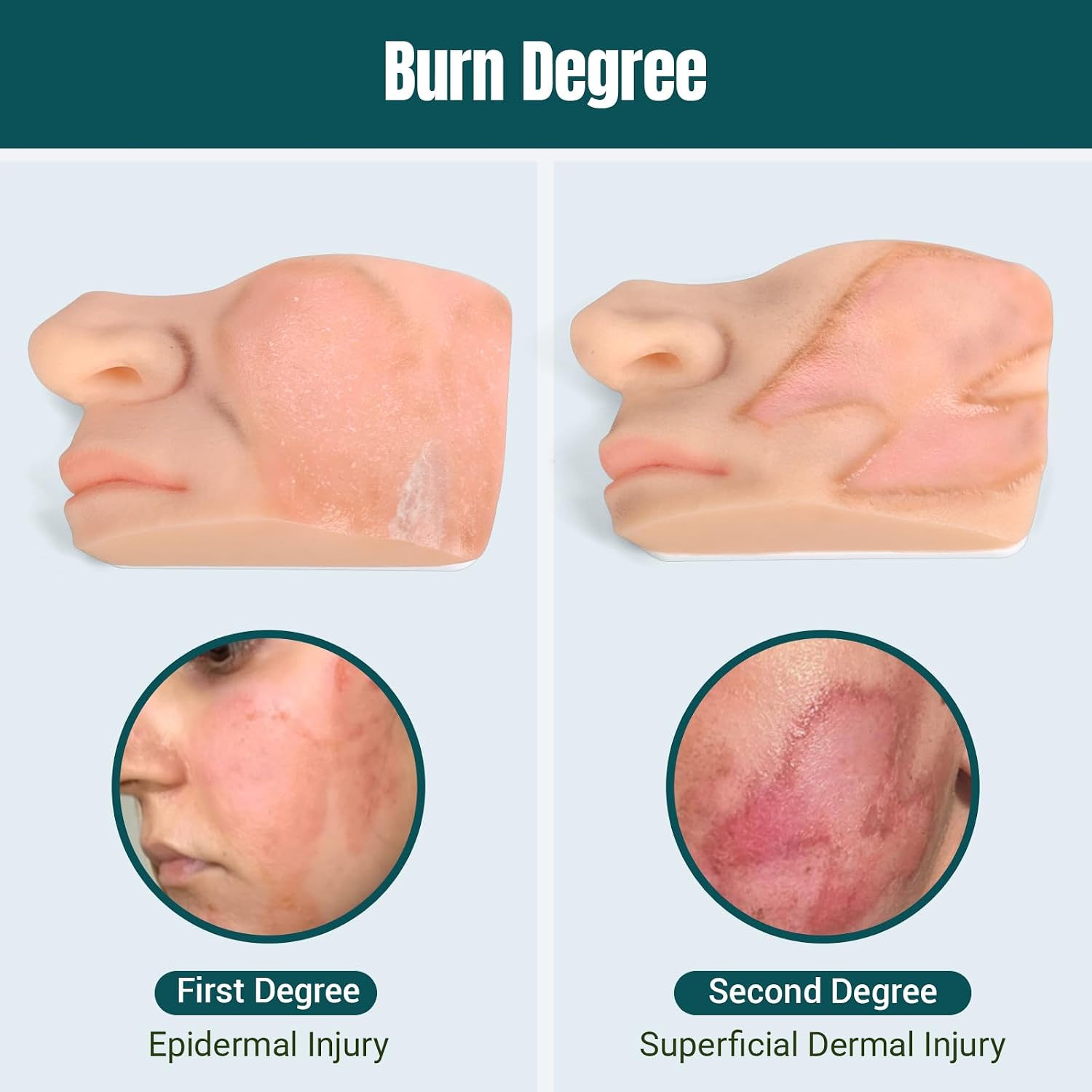 Facial Burn Wound Models Showing Different Burn Severity Levels
