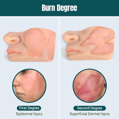 Facial Burn Wound Models Showing Different Burn Severity Levels