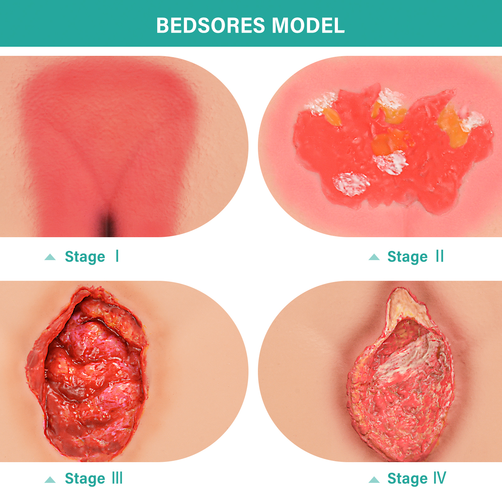 MedEduQuest Decubitus Ulcer Wound Care Model, Stage 1 to 4