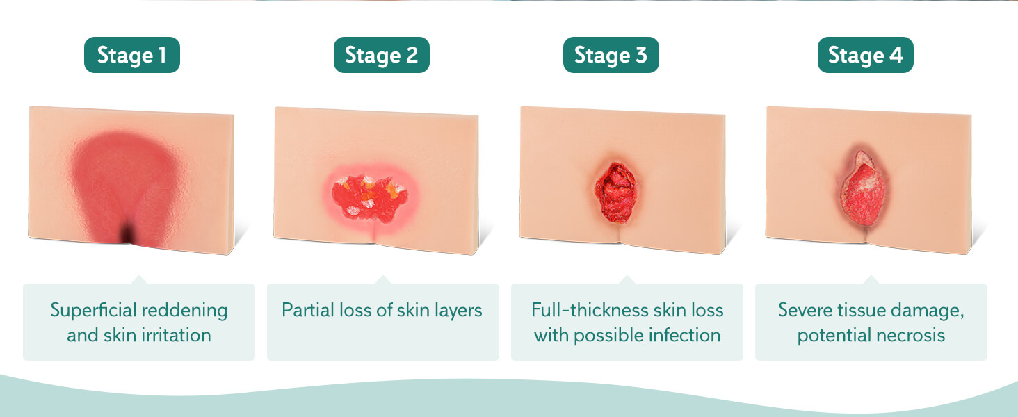 MedEduQuest Decubitus Ulcer Wound Care Model, Stage 1-4