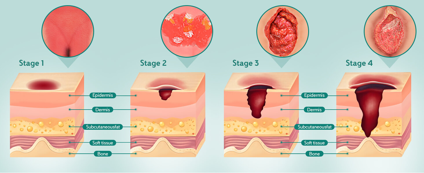 Realistic MedEduQuest Decubitus Ulcer Wound Care Model