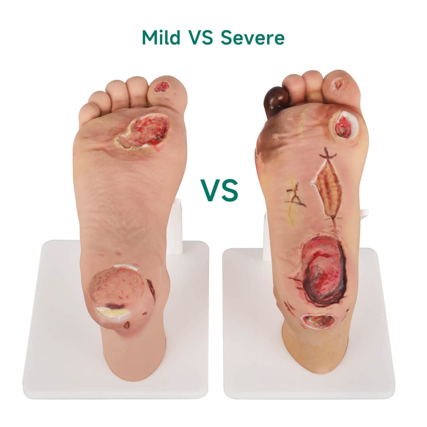 Diabetic Foot Model Mild Stage Vs Severe Stage