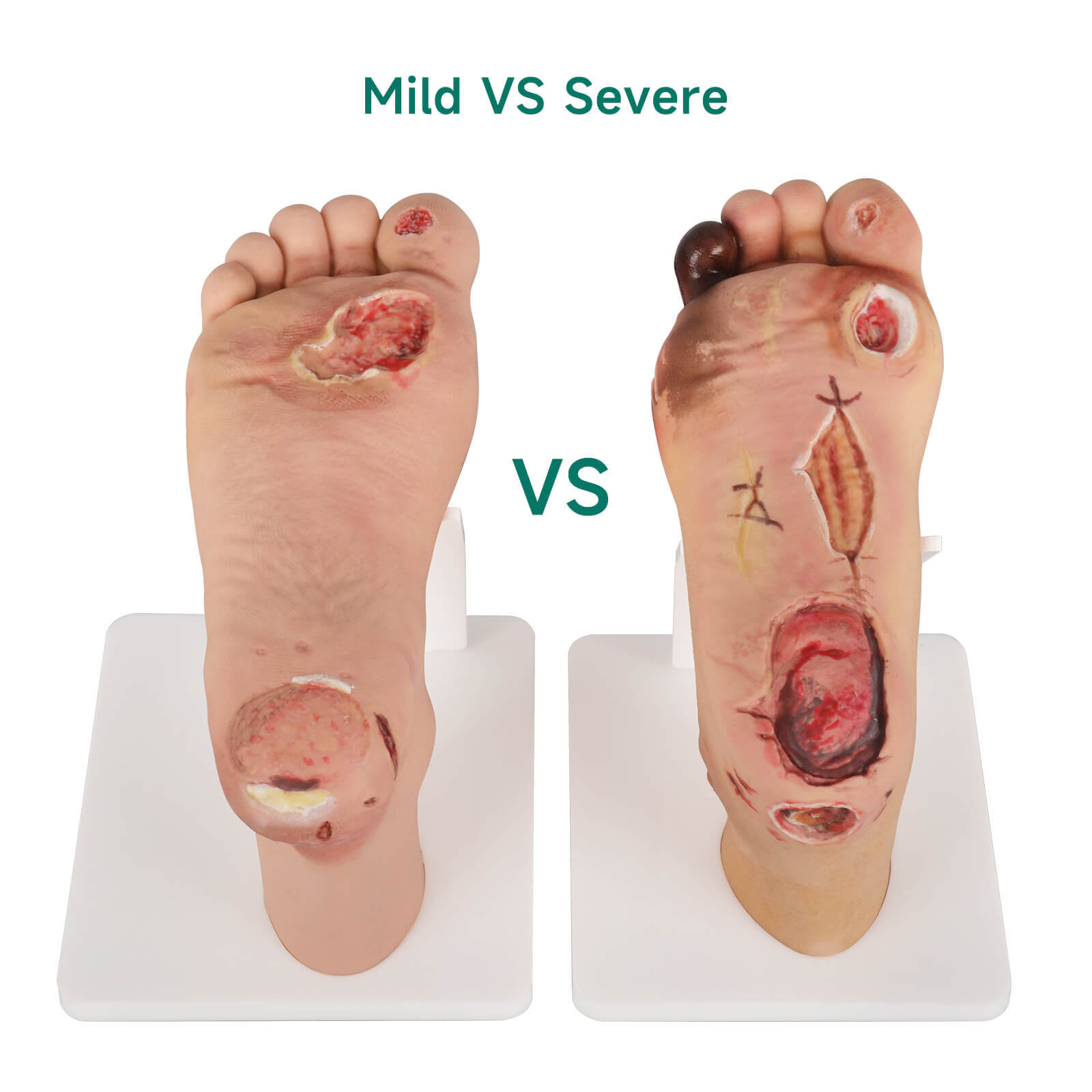 Diabetic Foot Model Mild Stage Vs Severe Stage