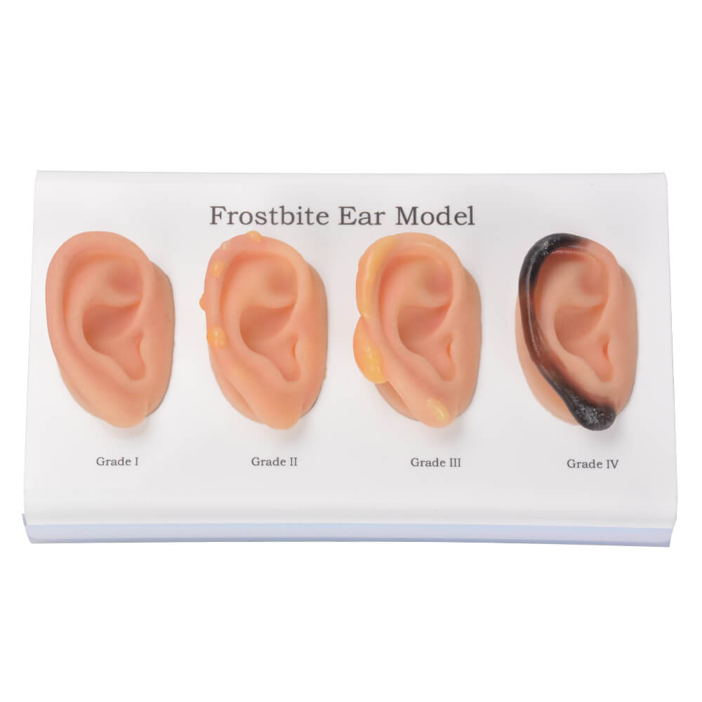 Ear Frostbite Pathology Progression Teaching Model Set (Grades I–IV)
