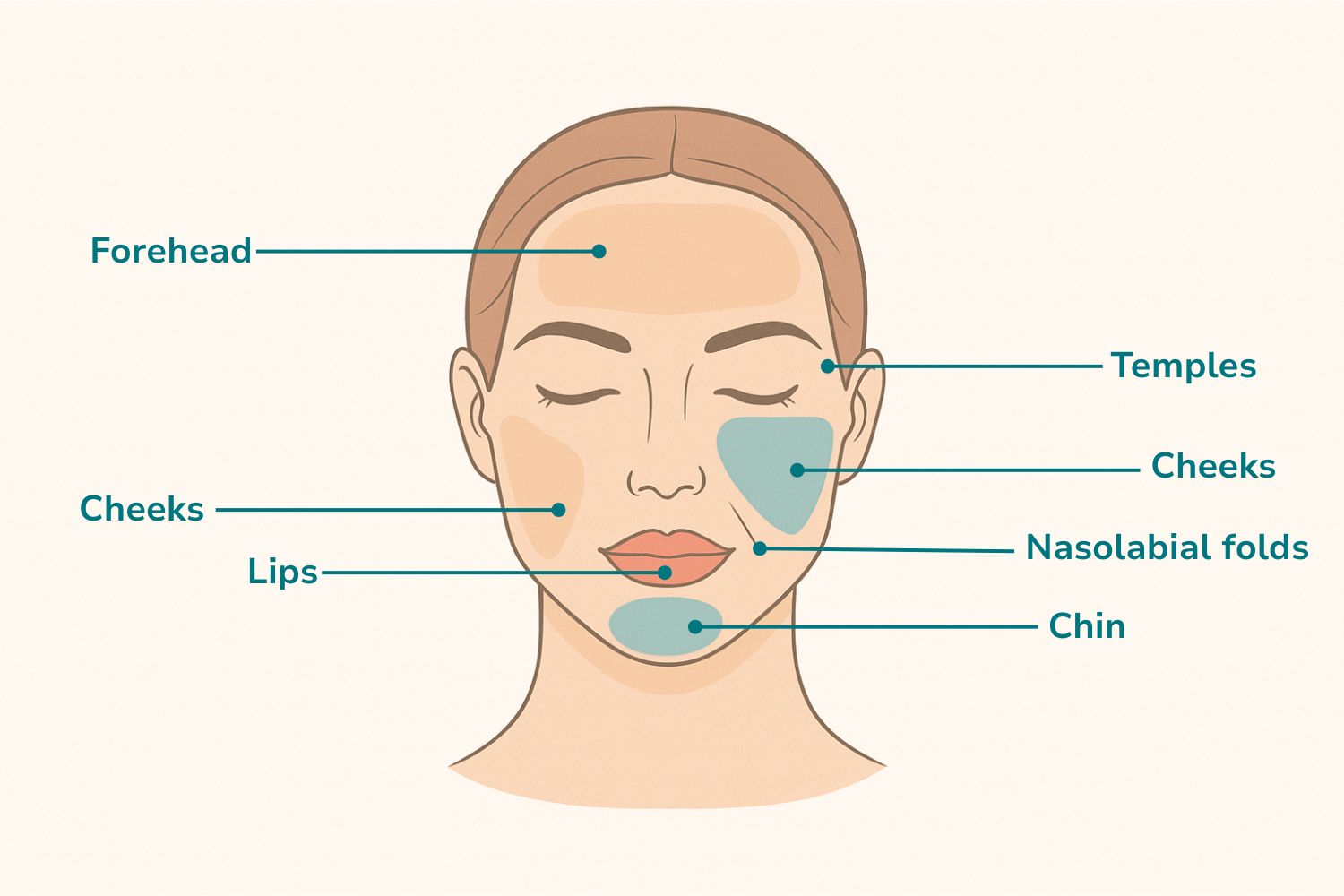 Facial Filller Injection Zones