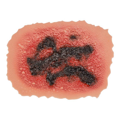 4th Degree Skin Burn Wound Moulage