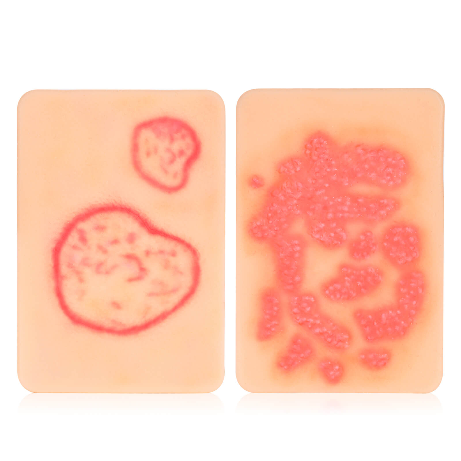 Palm-Sized Fungal Infection Wound Model Set (2 Pieces)