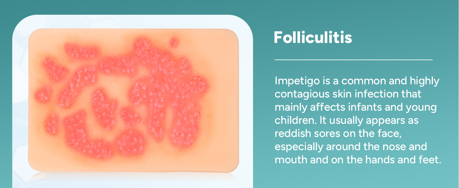 Palm-Sized Fungal Infection Wound Models(2-Pack)