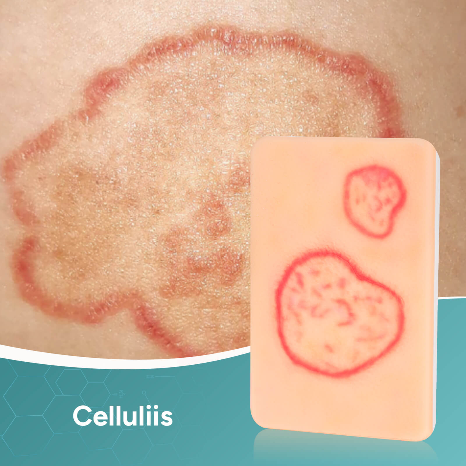 Palm-Sized Fungal Infection Wound Model Set (2 Pieces)