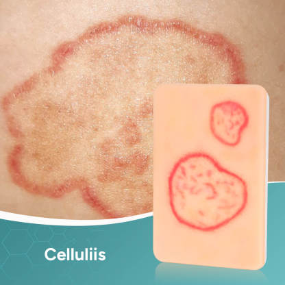 Palm-Sized Fungal Infection Wound Model Set (2 Pieces)