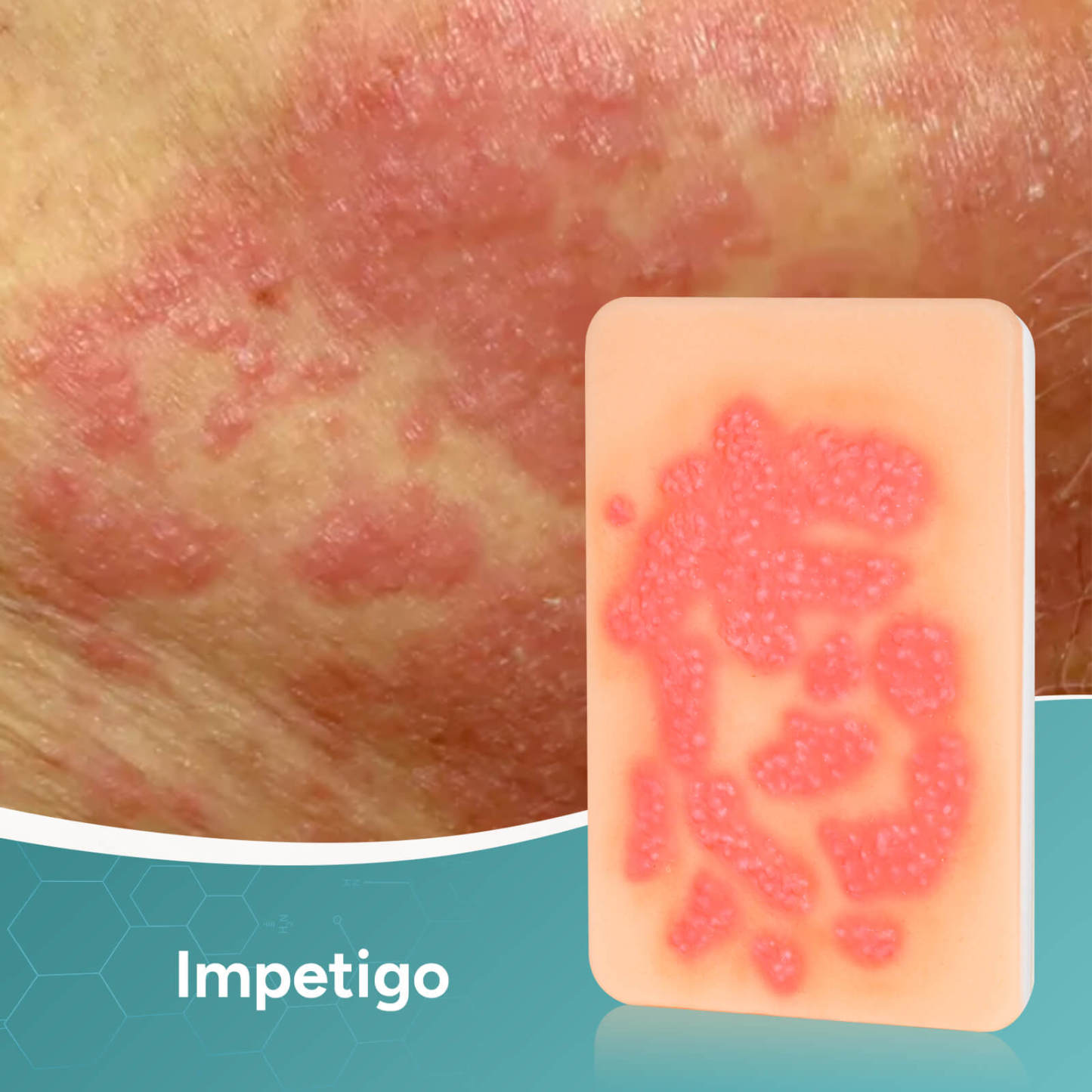 Palm-Sized Fungal Infection Wound Model Set (2 Pieces)