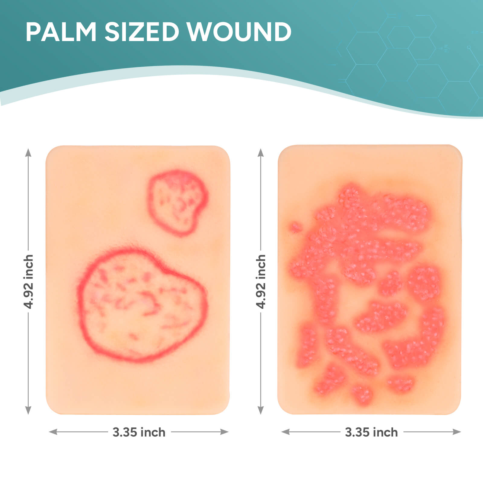 Palm-Sized Fungal Infection Wound Model Set (2 Pieces)