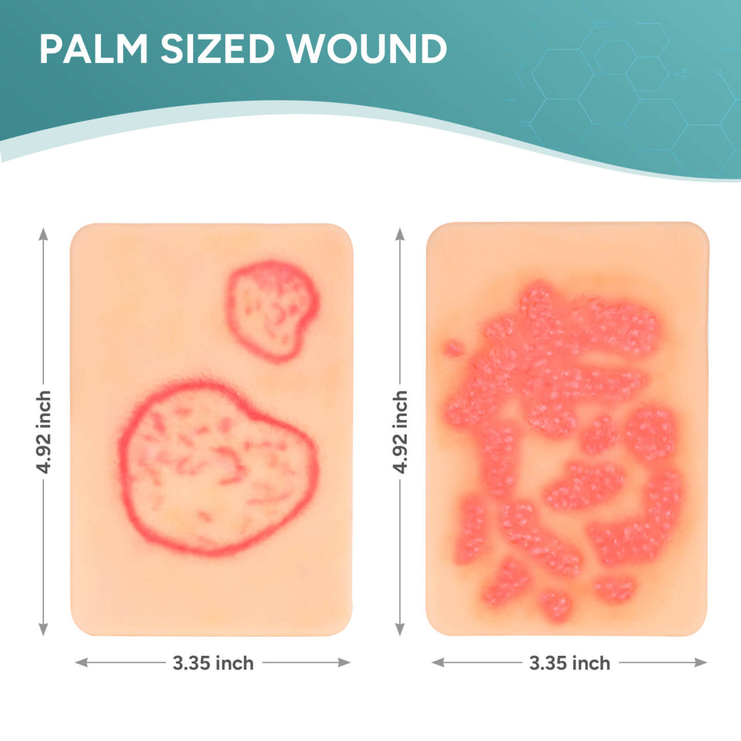 Palm-Sized Fungal Infection Wound Model Set (2 Pieces)