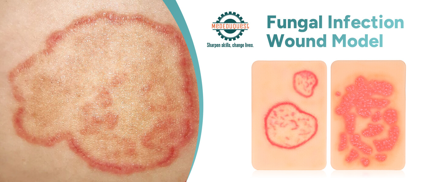 Palm-Sized Fungal Infection Wound Model Set (2 Pieces)