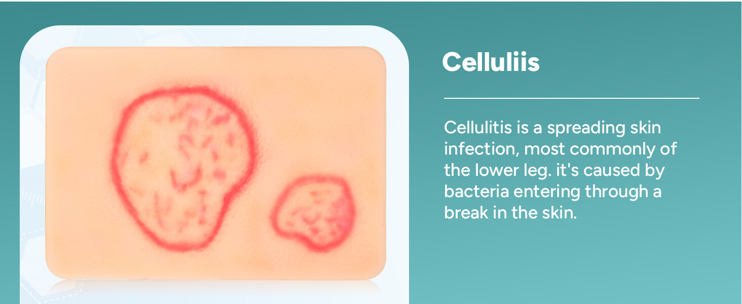 Palm-Sized Fungal Infection Wound Models