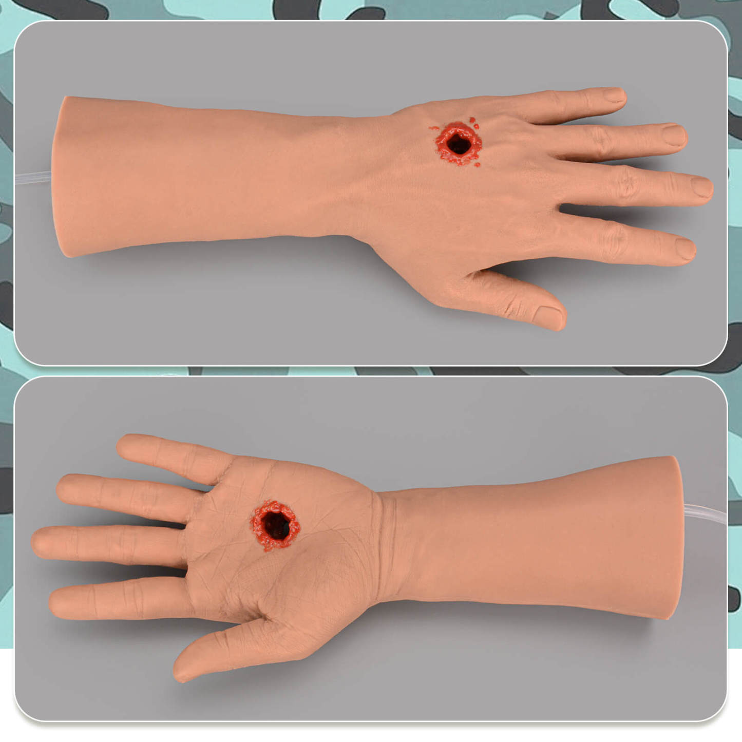 Tourniquet Hand with Gunshot Wound on Palm