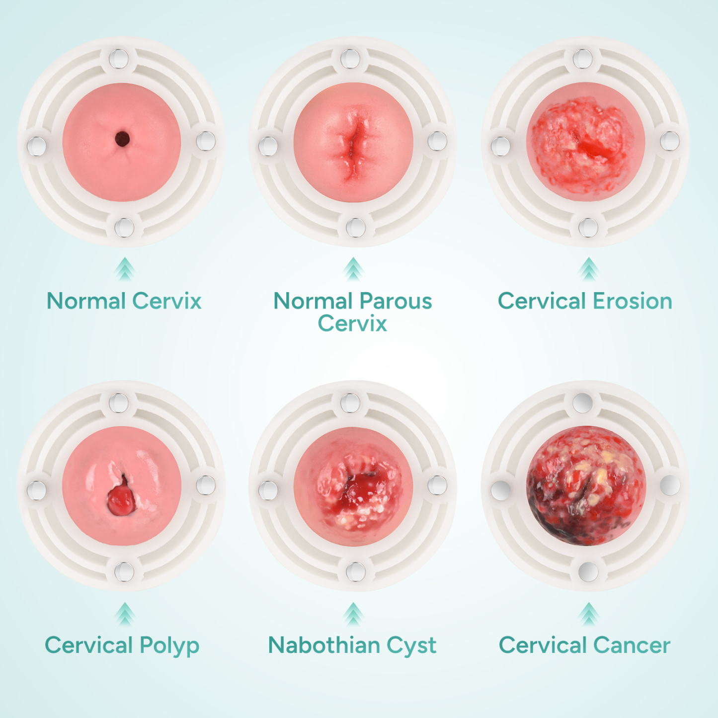 Gynecological Examination Model with 6 Cervical Pathology Replacements