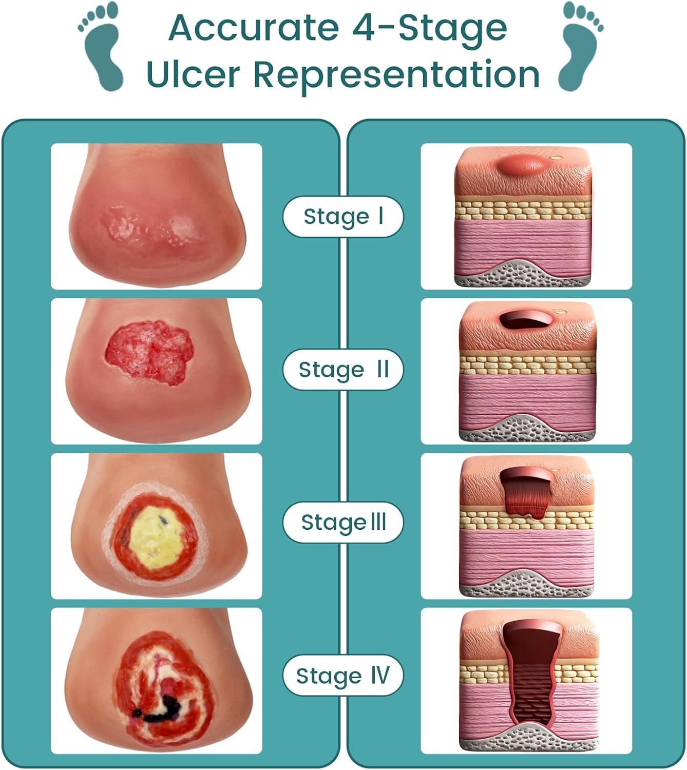 Heel Pressure Injury Stages Demonstration Model (Stage I–IV)