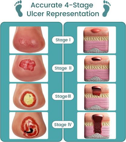 Heel Pressure Injury Stages Demonstration Model (Stage I–IV)
