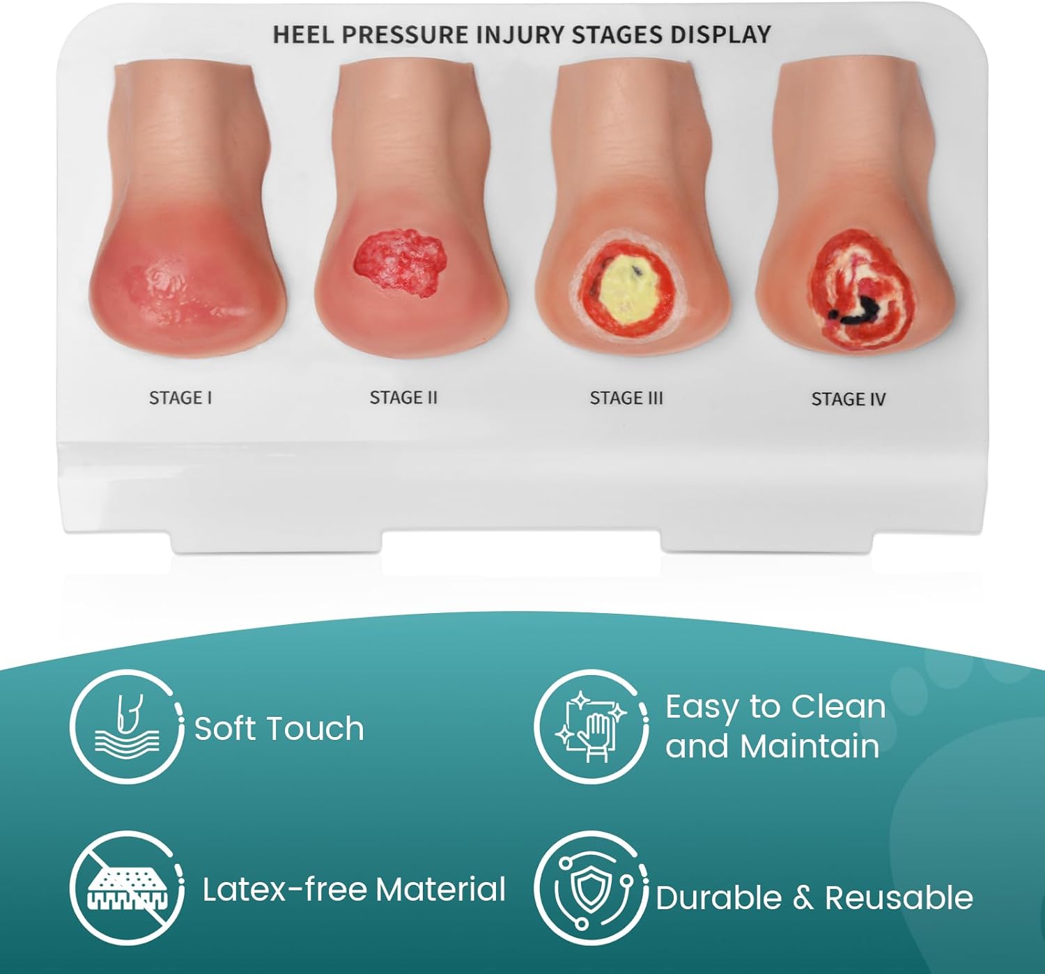 Heel Pressure Injury Stages Demonstration Model (Stage I–IV)