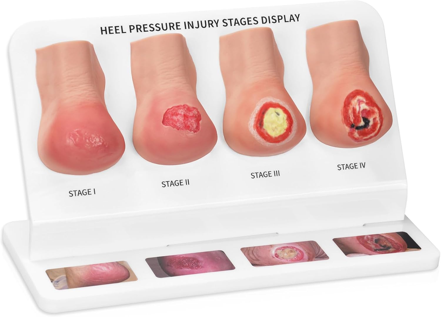 Heel Pressure Injury Stages Demonstration Model (Stage I–IV)
