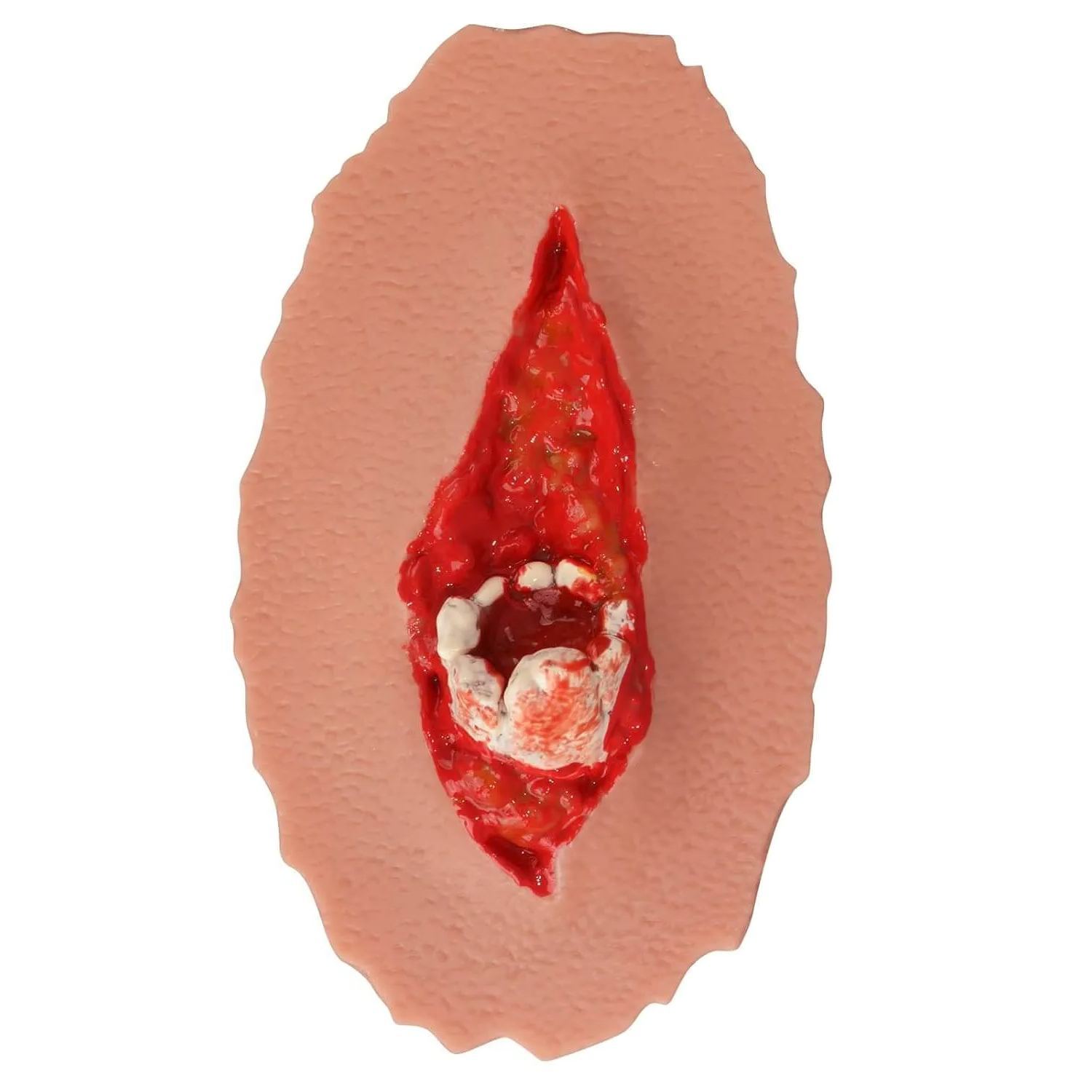 Adhensive Open Fracture Wound Moulage Grade 2